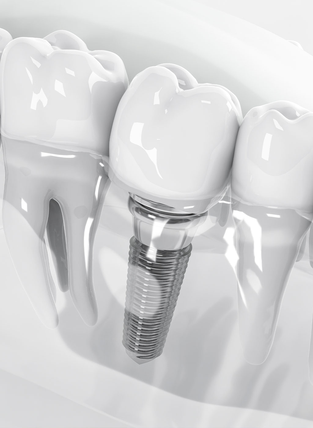 Zahnimplantat Behandlung OFM