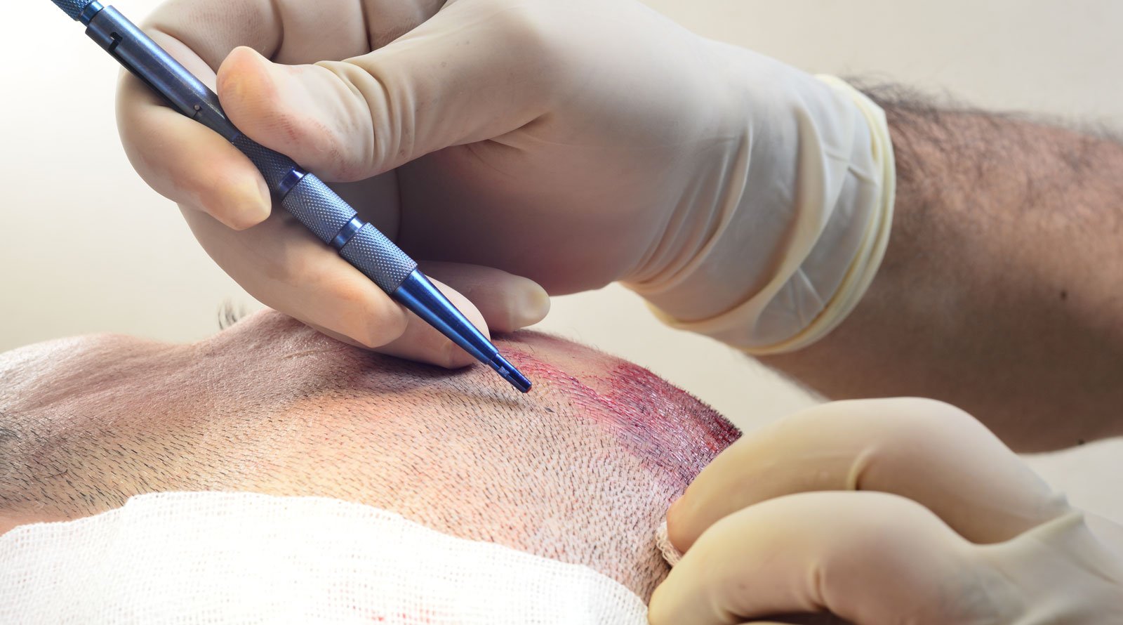 Saphir FUE Haartransplantation OFM